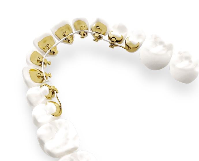 <p class="p1">Aligners, ceramic <span class="s1">or</span> lingual brackets – we choose what fits your goals <span class="s1">and</span> lifestyle.</p>