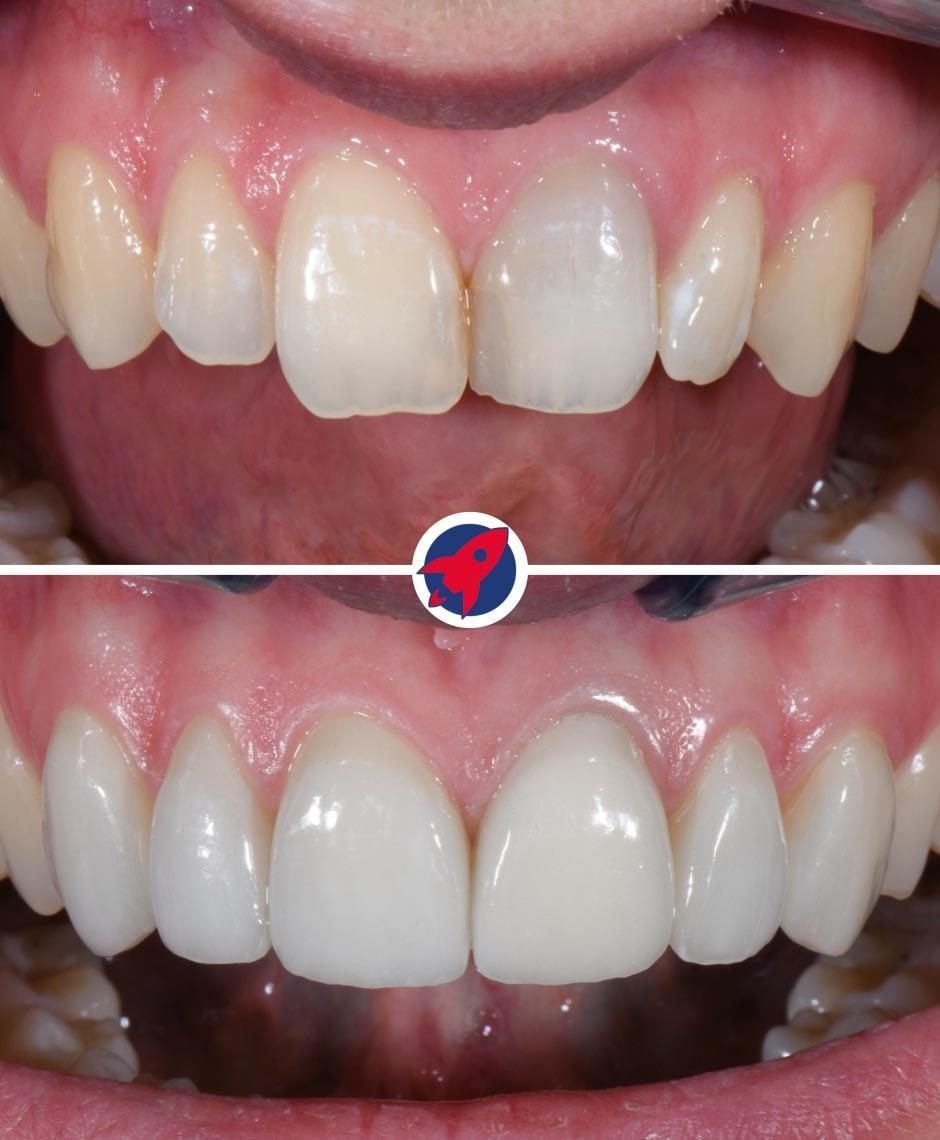 Vorher-Nachher-Aufnahmen zeigen die erfolgreiche ästhetische Transformation einer Patientin, die für die einzigartige Kombination aus Kieferorthopädie und ästhetisch-restaurativer Zahnmedizin zu Dr. Horvath kam: Durch Invisalign und sechs maßgefertigte Veneers erreichte sie ihr Ziel eines geraden, gleichmäßigen und aufgehellten Lächelns.