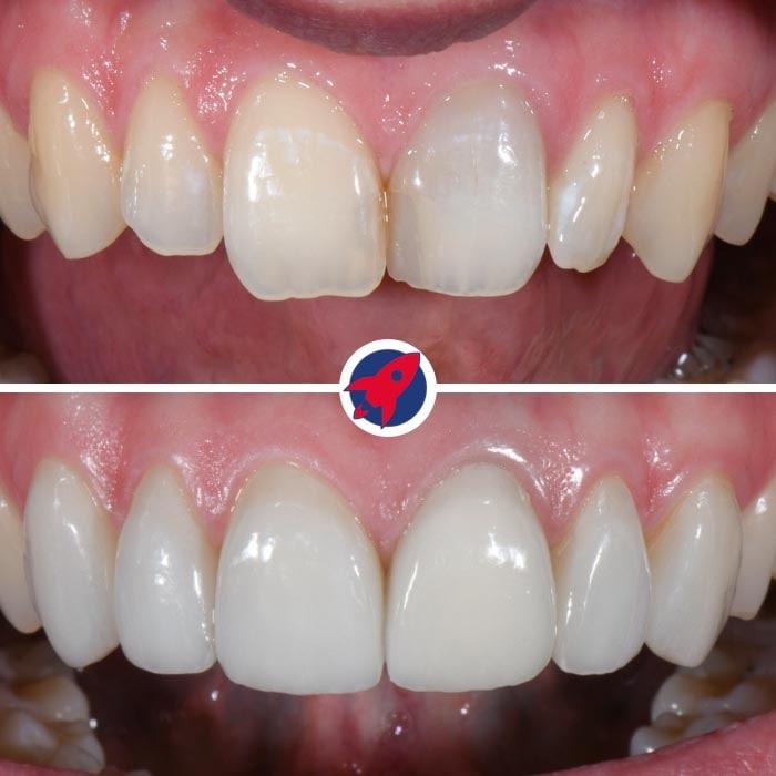 Vorher-Nachher-Aufnahmen zeigen die erfolgreiche ästhetische Transformation einer Patientin, die für die einzigartige Kombination aus Kieferorthopädie und ästhetisch-restaurativer Zahnmedizin zu Dr. Horvath kam: Durch Invisalign und sechs maßgefertigte Veneers erreichte sie ihr Ziel eines geraden, gleichmäßigen und aufgehellten Lächelns.