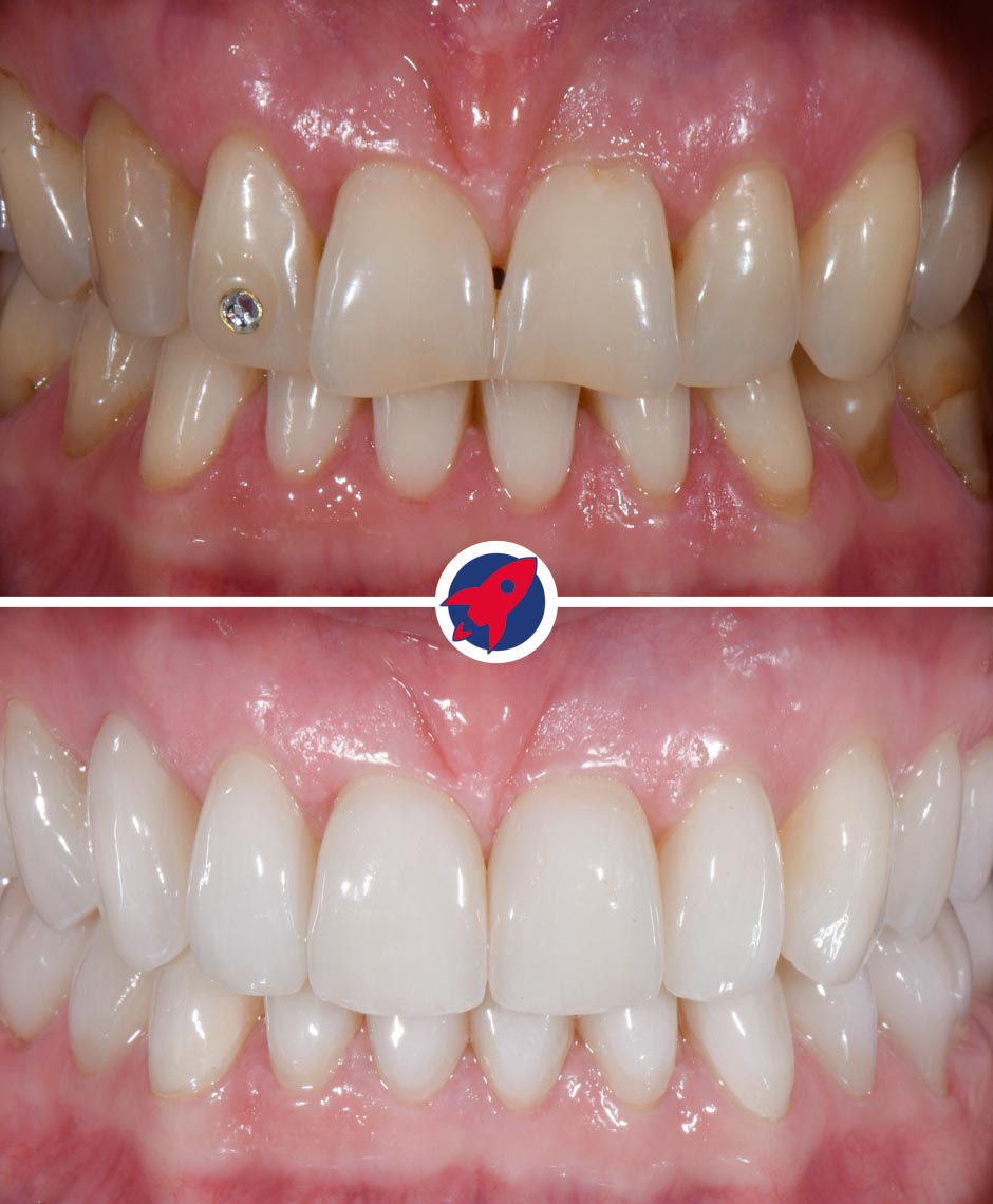 Vorher-Nachher-Aufnahmen einer anspruchsvollen ästhetischen Zahnbehandlung: Durch die präzise Kombination von Invisalign und individuell gefertigten Veneers konnte bei der Patientin eine asymmetrische Zahnfehlstellung korrigiert und der Wunsch nach einem strahlend weißen, perfekten Lächeln erfüllt werden.