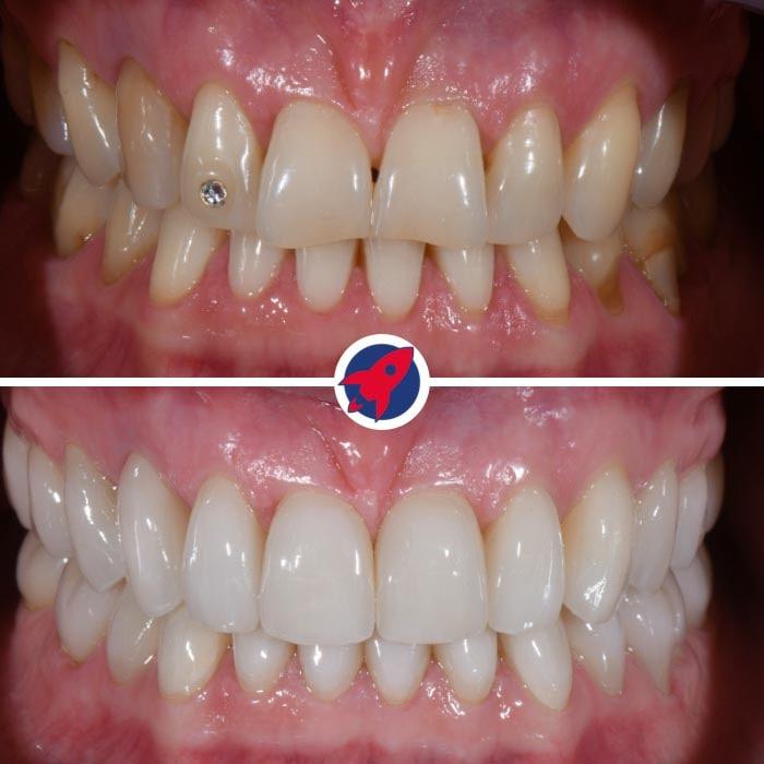 Vorher-Nachher-Aufnahmen einer anspruchsvollen ästhetischen Zahnbehandlung: Durch die präzise Kombination von Invisalign und individuell gefertigten Veneers konnte bei der Patientin eine asymmetrische Zahnfehlstellung korrigiert und der Wunsch nach einem strahlend weißen, perfekten Lächeln erfüllt werden.