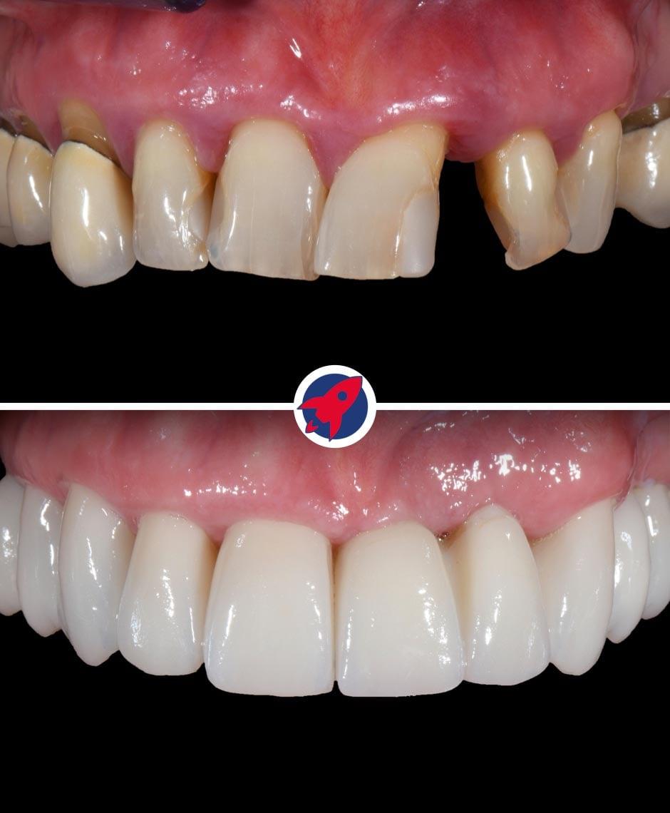 <p class="p1">Implants and crowns for function and aesthetics</p>