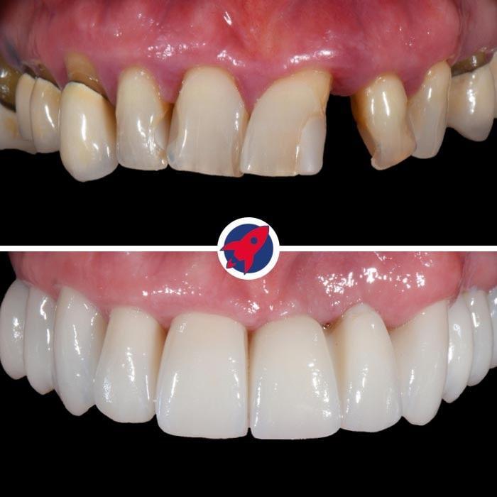 <p class="p1">Implants and crowns for function and aesthetics</p>