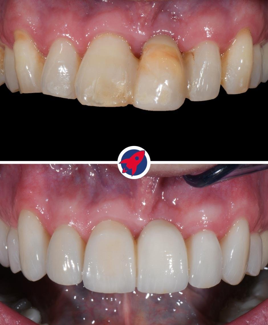 Vorher-Nachher-Bilder der Zahnsanierung eines erfolgreichen Bankiers: Von Invisalign-behandelten Fehlstellungen zu einem makellosen Lächeln mit Veneers und Zahnbrücken, maßgeschneidert für den anspruchsvollen Terminplan eines Geschäftsmannes.