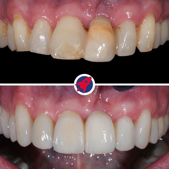 Vorher-Nachher-Bilder der Zahnsanierung eines erfolgreichen Bankiers: Von Invisalign-behandelten Fehlstellungen zu einem makellosen Lächeln mit Veneers und Zahnbrücken, maßgeschneidert für den anspruchsvollen Terminplan eines Geschäftsmannes.