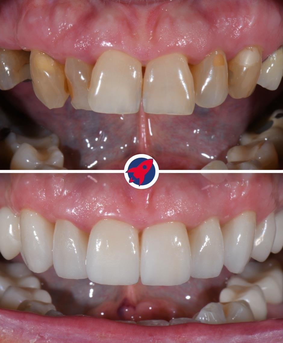 <p class="p1">Invisalign, implant, crowns and veneers</p>