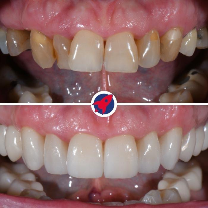 <p class="p1">Invisalign, implant, crowns and veneers</p>