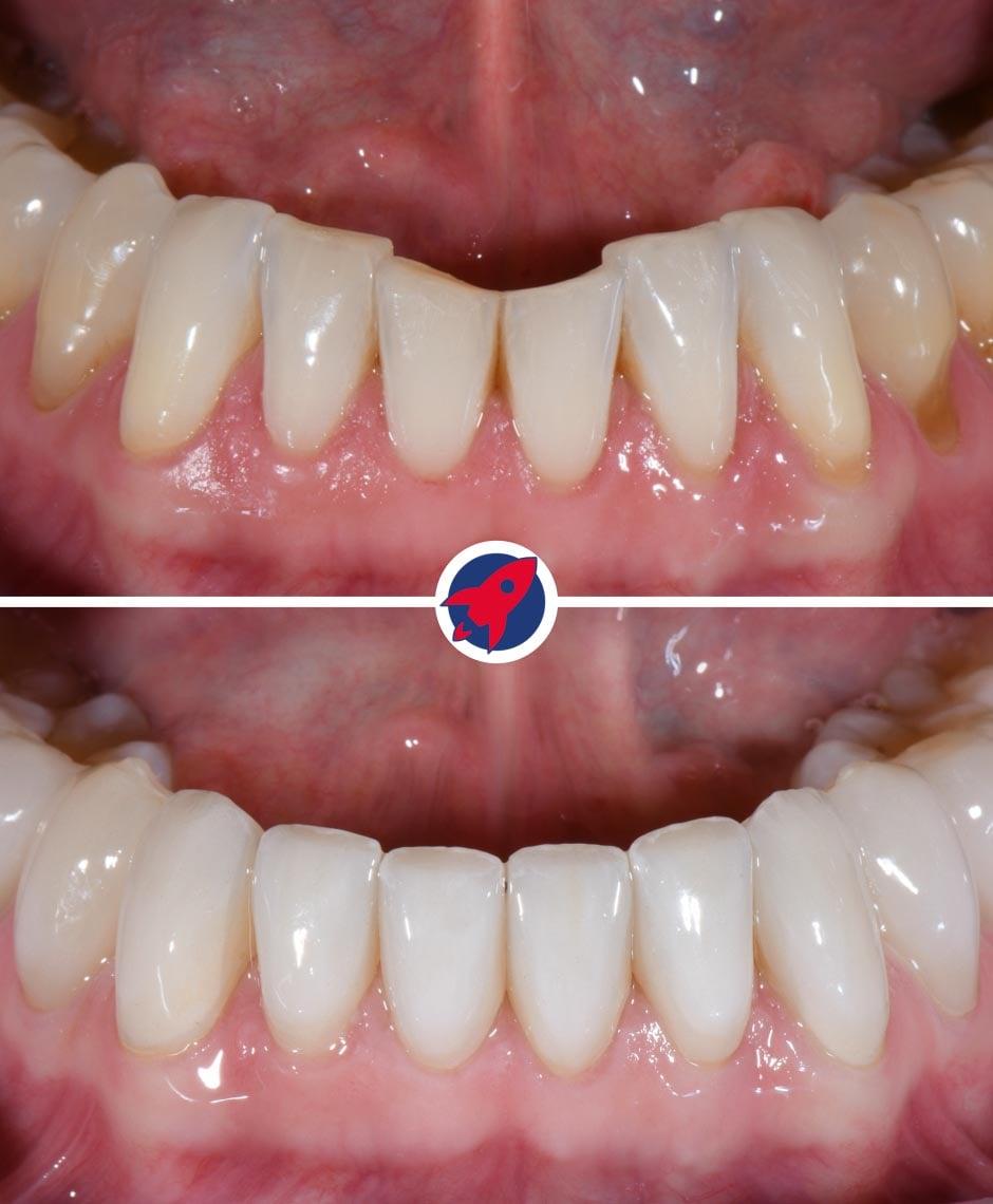 Vorher-Nachher: Korrektur der Unterkiefer-Frontzähne mit Invisalign. Danach wurden die Zähne mit Veneers veredelt, was zu einem makellosen und ästhetischen Ergebnis führte.