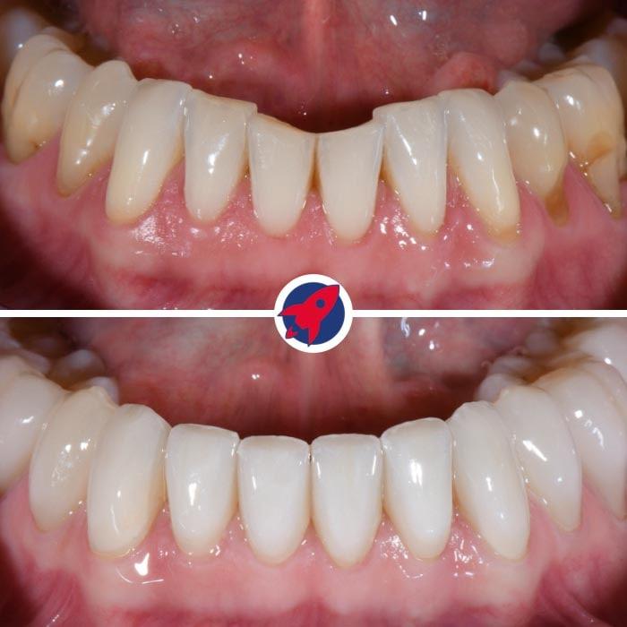 Vorher-Nachher: Korrektur der Unterkiefer-Frontzähne mit Invisalign. Danach wurden die Zähne mit Veneers veredelt, was zu einem makellosen und ästhetischen Ergebnis führte.