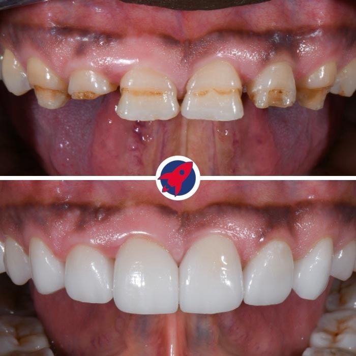 <p class="p1">Orthodontics and veneers for a natural result</p>