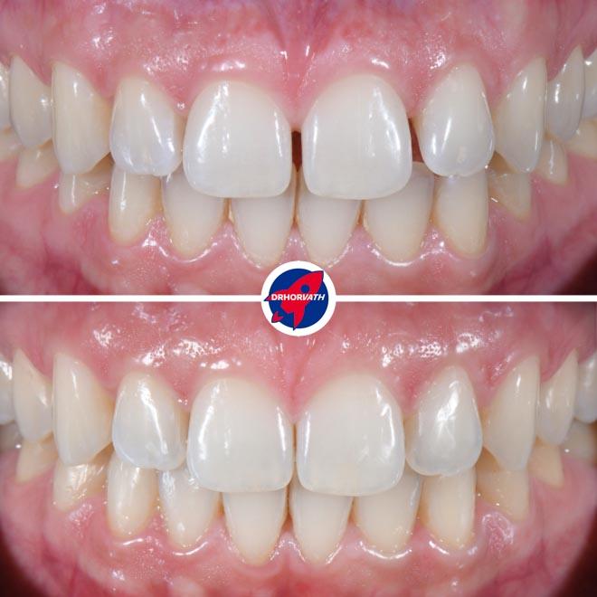 Vorher–nachher Invisalign: Frontzahnlücken zu geschlossenen, harmonischen Kontaktpunkten; Dr. Horvath, Jestetten bei Zürich.