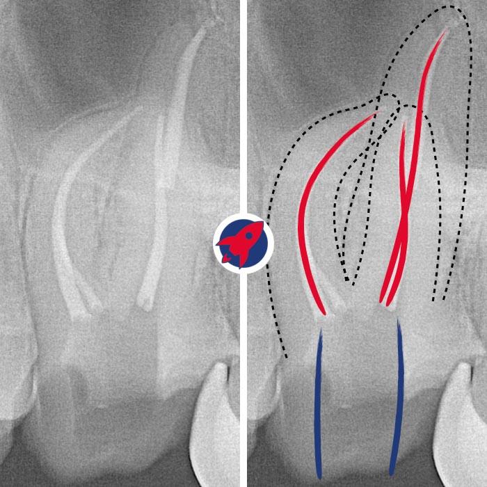 Röntgenbild einer idealen Wurzelkanalbehandlung an Zahn 26 in der Praxis Dr. Horvath in Jestetten nahe Zürich