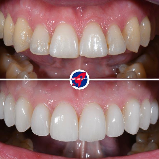 Vorher–nachher Veneers bei junger Frau: unregelmäßige, durch Abnutzung gezeichnete Frontzähne zu natürlich wirkenden Keramikveneers; Praxis Dr. Horvath, Jestetten bei Zürich.