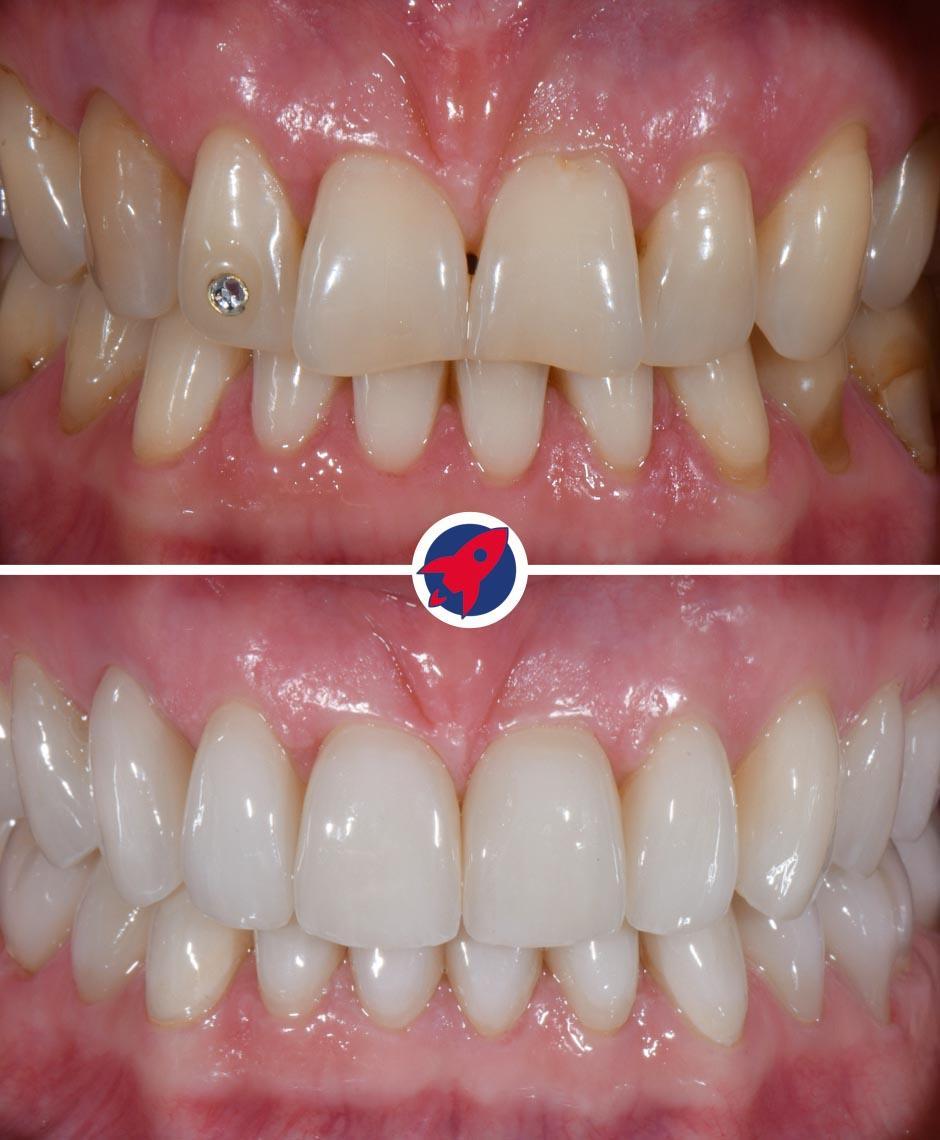 Vorher-Nachher-Aufnahmen einer anspruchsvollen ästhetischen Zahnbehandlung: Durch die präzise Kombination von Invisalign und individuell gefertigten Veneers konnte bei der Patientin eine asymmetrische Zahnfehlstellung korrigiert und der Wunsch nach einem strahlend weißen, perfekten Lächeln erfüllt werden.