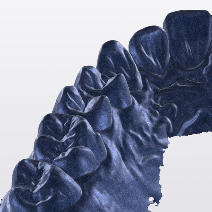 3D Zahnscan, erstellt mit unserem Intraoralscanner in unserer Praxis in Jestetten.