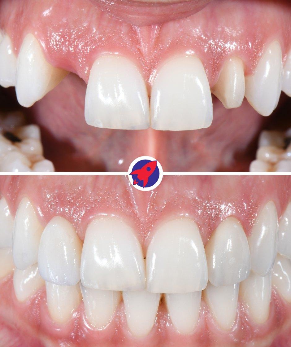 <p class="p1"><span class="s1">Minimally Invasive</span></p>