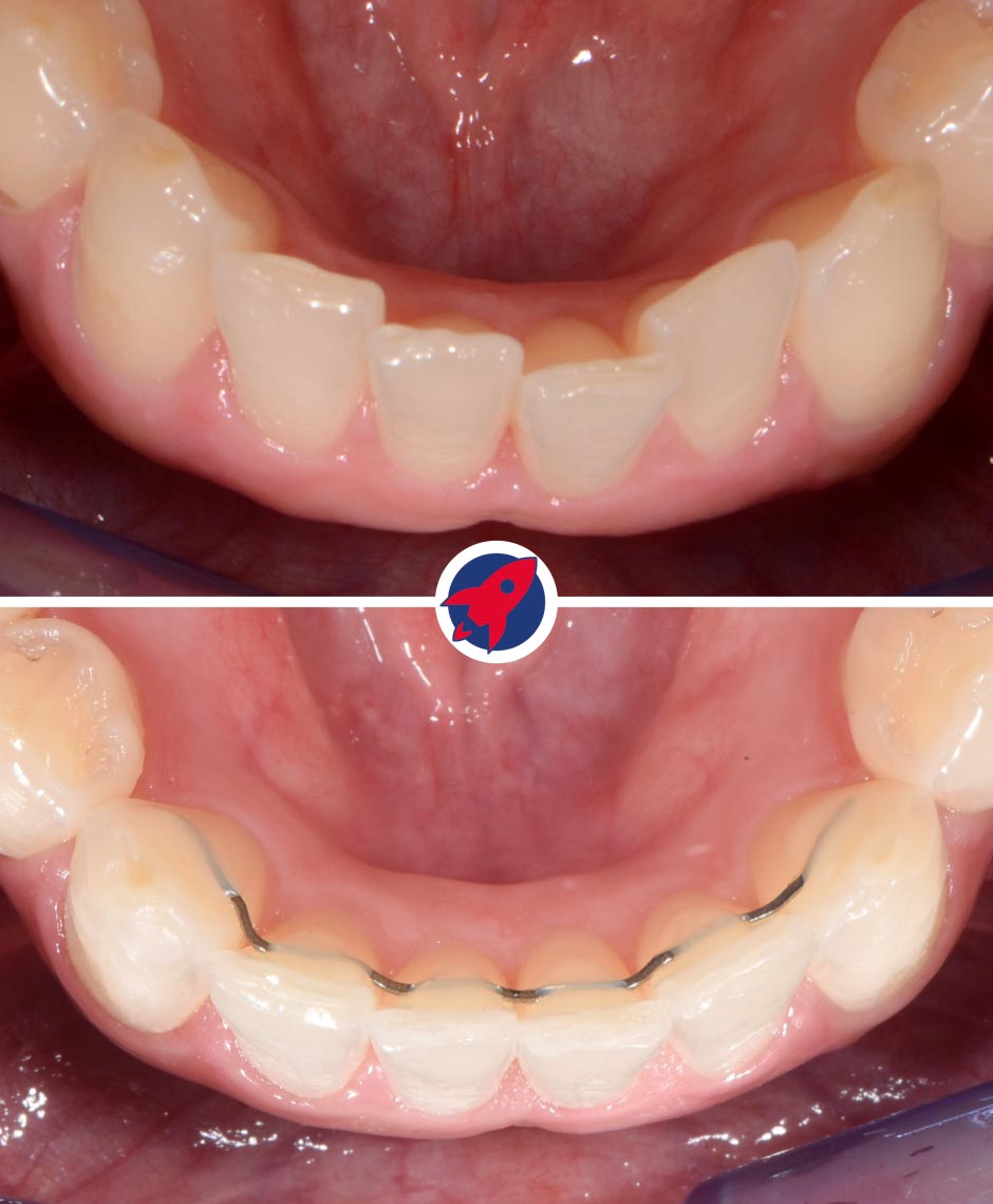 Vorher-Nachher Zahnkorrektur Unterkiefer mit festem Retainer – stabile Kieferorthopädie Ergebnis