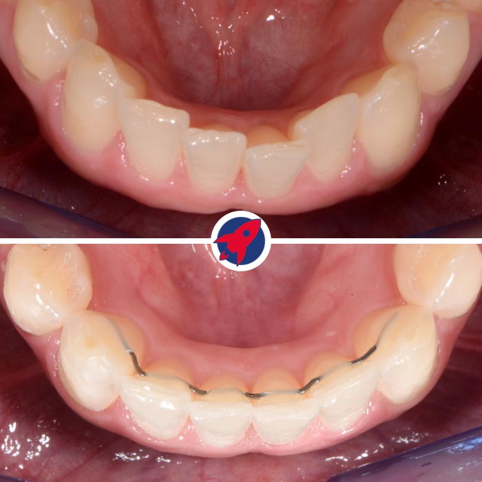 Vorher-Nachher Zahnkorrektur Unterkiefer mit festem Retainer – stabile Kieferorthopädie Ergebnis