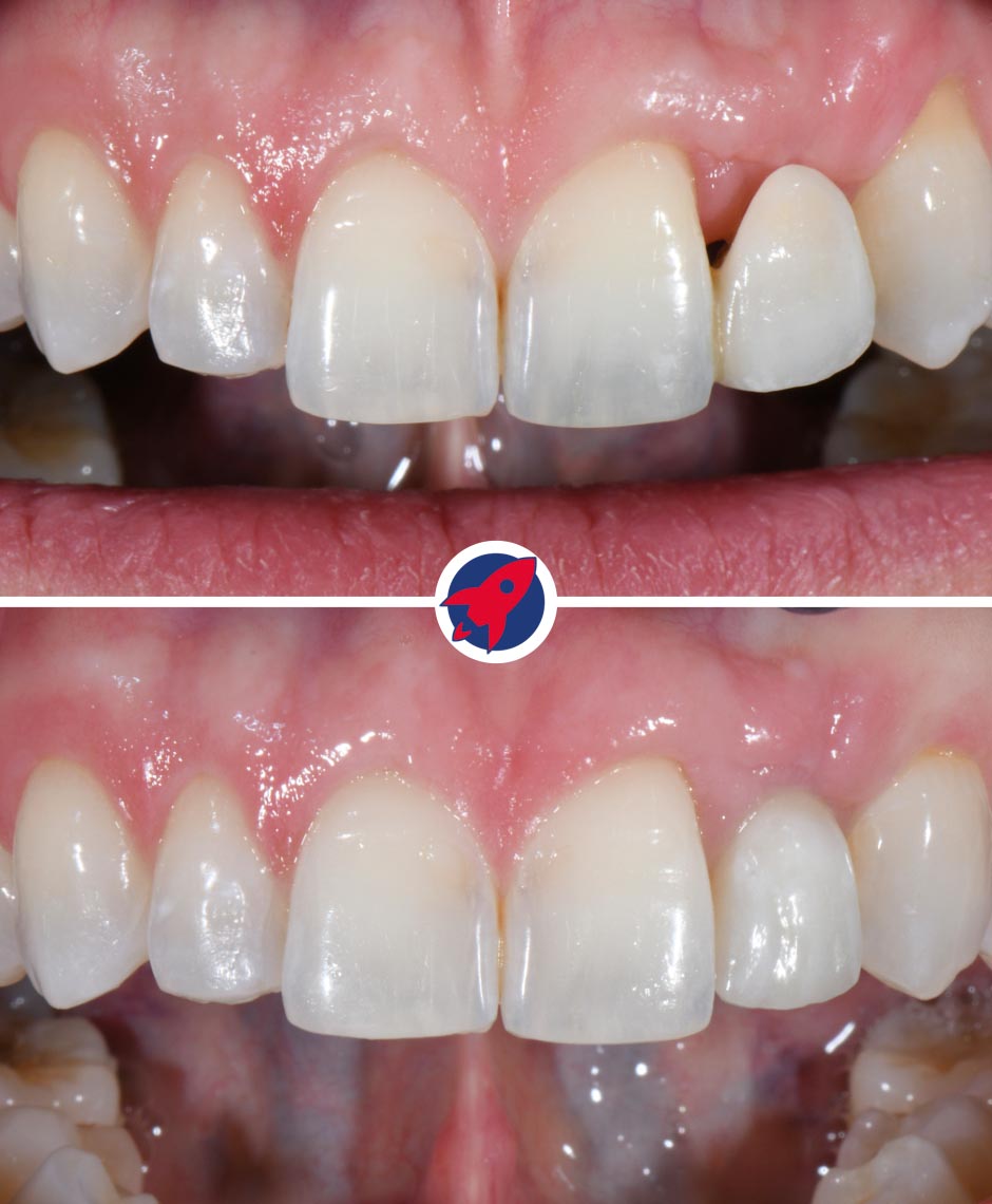 Vorher-nachher Implantatbehandlung am seitlichen Schneidezahn mit mikrochirurgischer Zahnfleischkorrektur zur Wiederherstellung von Funktion und Ästhetik