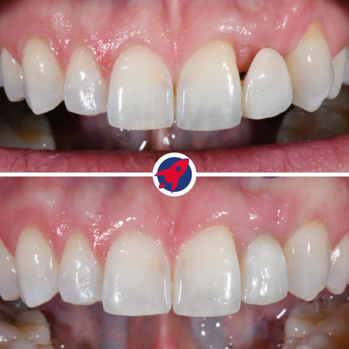 Vorher-nachher Implantatbehandlung am seitlichen Schneidezahn mit mikrochirurgischer Zahnfleischkorrektur zur Wiederherstellung von Funktion und Ästhetik