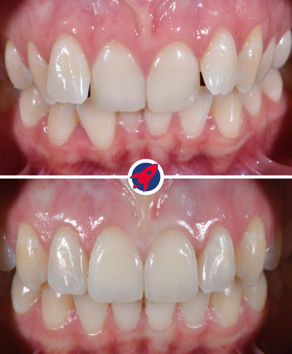 Vorher-nachher Ergebnis einer Invisalign-Behandlung bei Engstand: gerade Zähne und verbesserte Funktion