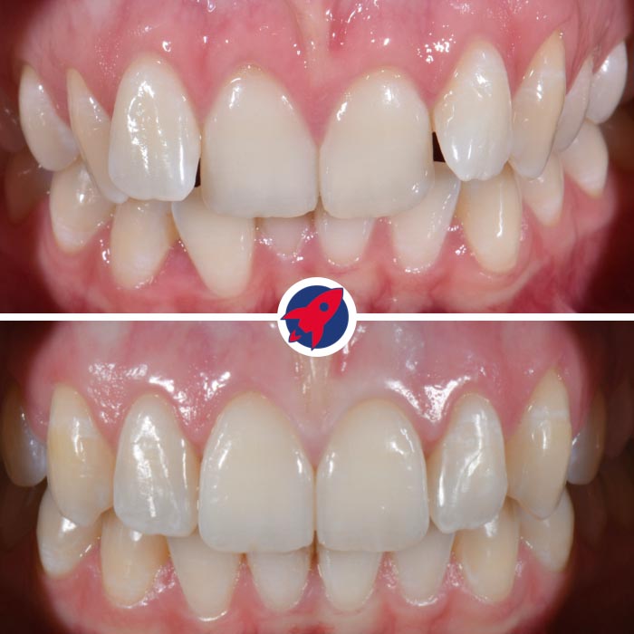 Vorher-nachher Ergebnis einer Invisalign-Behandlung bei Engstand: gerade Zähne und verbesserte Funktion