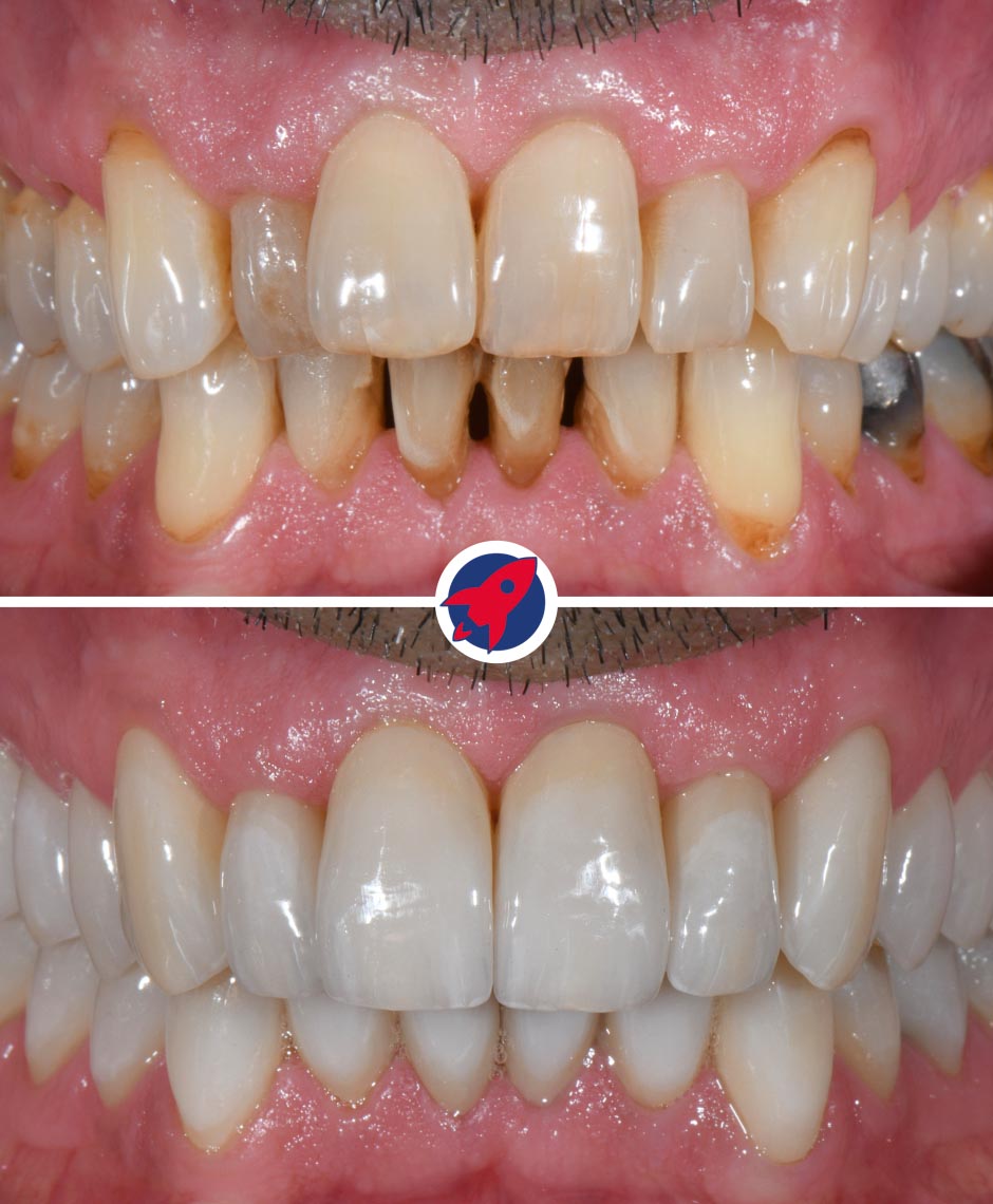 Vorher-nachher Ergebnis einer kompletten Zahnsanierung mit Invisalign und 28 Veneers für gerade, helle und natürlich wirkende Zähne