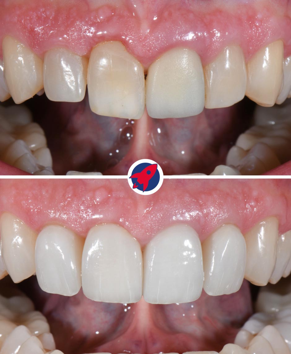 Vorher-nachher Behandlung asymmetrischer Abnutzung mit Invisalign und Veneers an oberen und unteren Frontzähnen für ein helles, harmonisches Lächeln