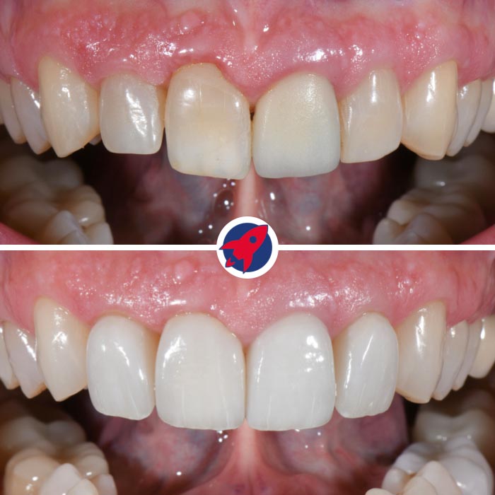 Vorher-nachher Behandlung asymmetrischer Abnutzung mit Invisalign und Veneers an oberen und unteren Frontzähnen für ein helles, harmonisches Lächeln
