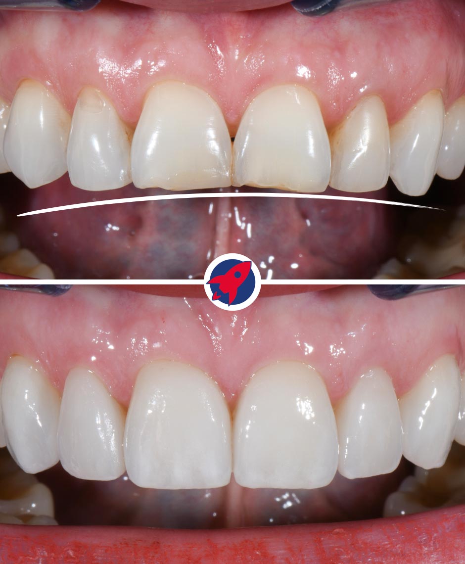 Vorher-nachher Behandlung einer Fehlstellung mit Invisalign und sechs Veneers zur Korrektur der Lachlinie und Wiederherstellung der Frontzähne