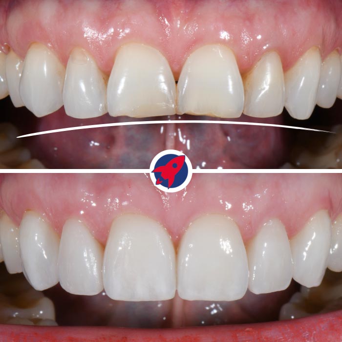 Vorher-nachher Behandlung einer Fehlstellung mit Invisalign und sechs Veneers zur Korrektur der Lachlinie und Wiederherstellung der Frontzähne