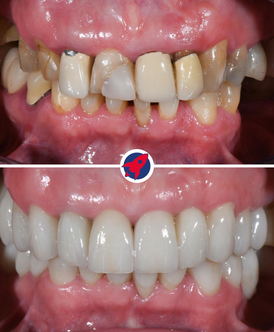 Vorher-nachher komplexe Zahnsanierung mit Implantaten, Invisalign und Kronen bei Parodontitis, Zahnabnutzung und Fehlstellung