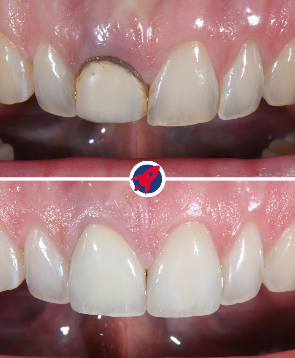 Vorher-nachher Ergebnis nach Behandlung eines verfärbten Frontzahns mit Zahnfleischkorrektur, Krone und Veneer für ein natürliches, symmetrisches Lächeln