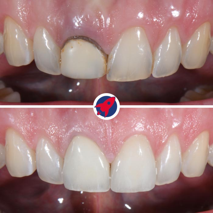 Vorher-nachher Ergebnis nach Behandlung eines verfärbten Frontzahns mit Zahnfleischkorrektur, Krone und Veneer für ein natürliches, symmetrisches Lächeln