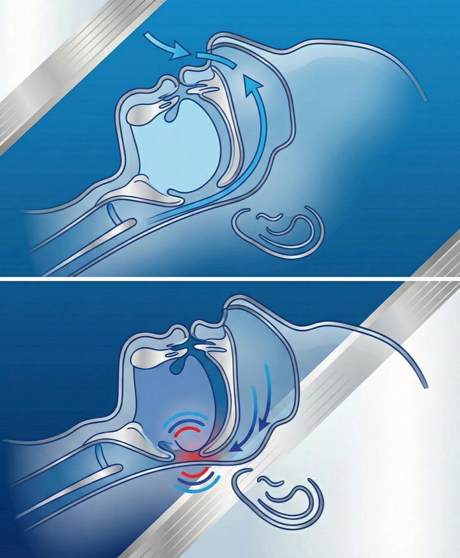 Schnarchen erklärt: Die Zunge rutscht im Schlaf nach hinten und verengt die Atemwege, wodurch Schnarchgeräusche entstehen.