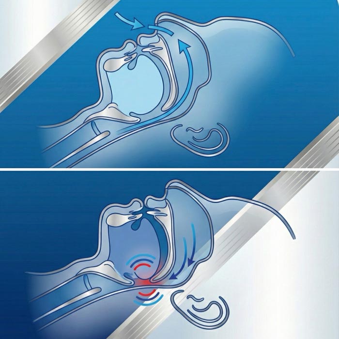 Schnarchen erklärt: Die Zunge rutscht im Schlaf nach hinten und verengt die Atemwege, wodurch Schnarchgeräusche entstehen.