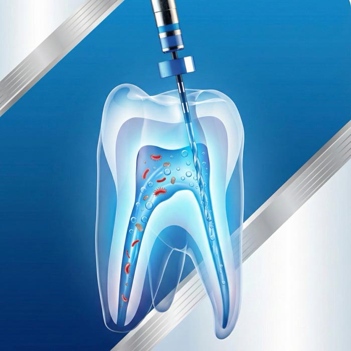 Desinfektion der Wurzelkanäle während einer Wurzelkanalbehandlung – sorgfältige Reinigung zur Entfernung von Bakterien und Entzündungen.