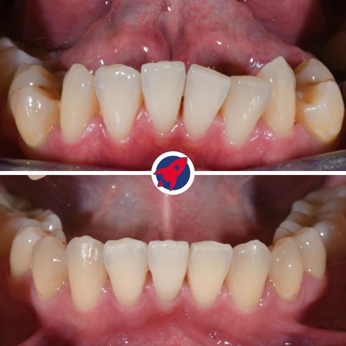 Vorher-Nachher-Vergleich: Zahnkorrektur einer ausgeprägten Fehlstellung mit fester Zahnspange – präzise kieferorthopädische Behandlung mit Brackets.