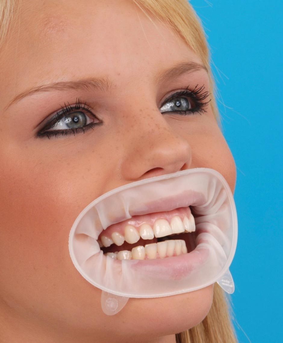 Patientin mit eingesetztem OptraGate zur sanften Lippen- und Wangenretraktion