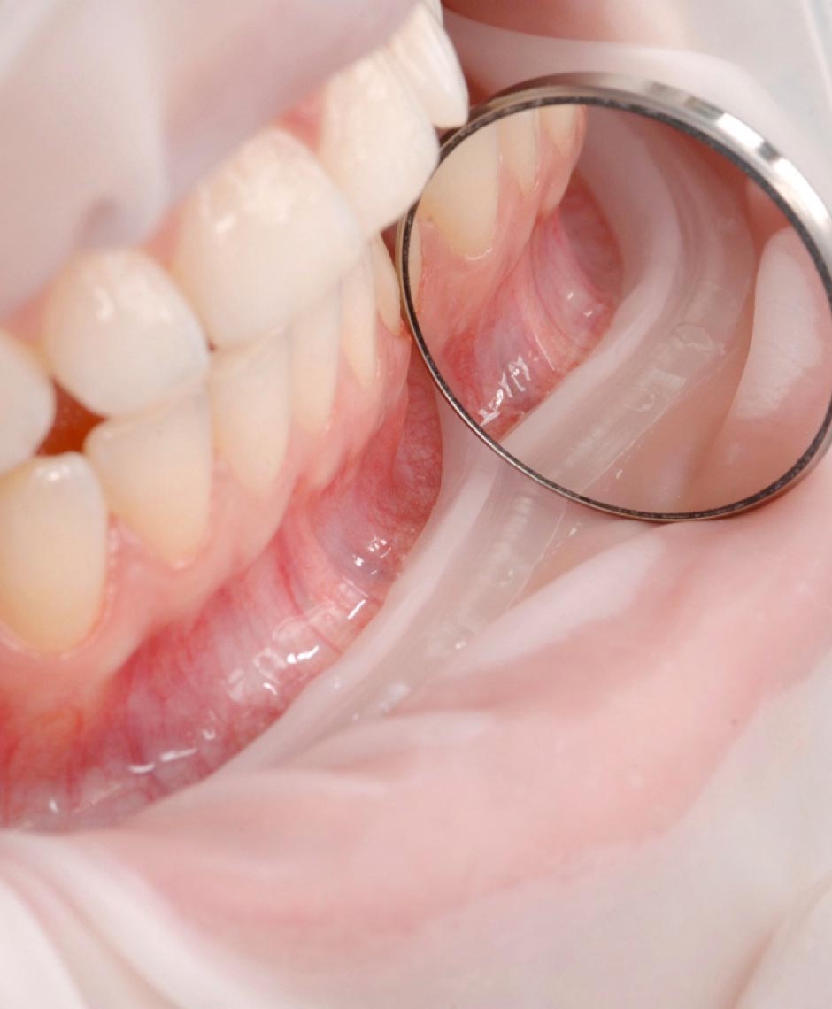 OptraGate im Mund – gleichmäßige Retraktion ohne sichtbare Druckstellen