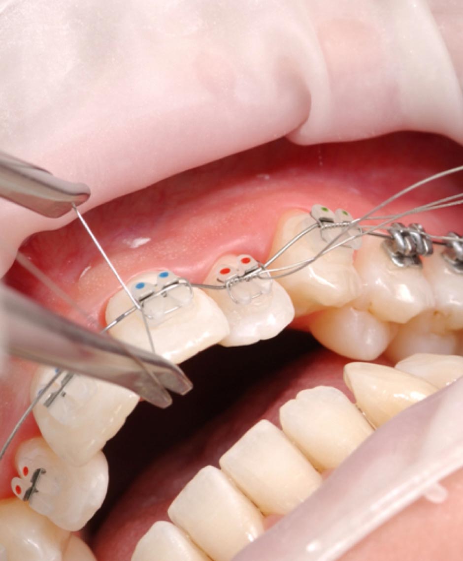OptraGate in der Kieferorthopädie für freien Zugang und bessere Sicht