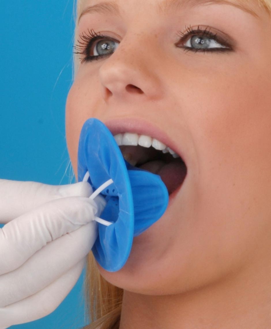 Einsetzen von OptraDam bei Patientin zur dentalen Isolation
