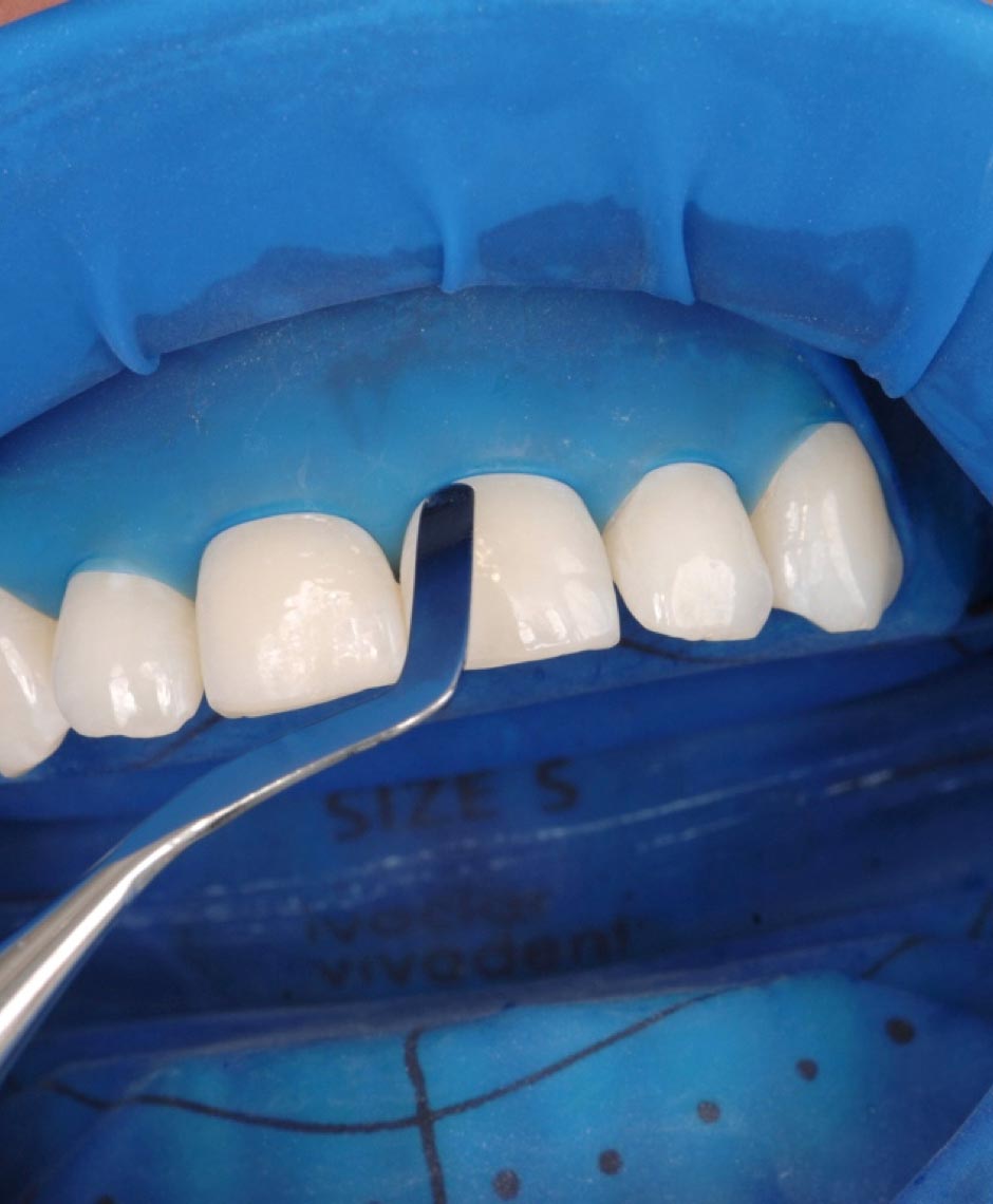 Isolation der Frontzähne mit OptraDam für präzises Arbeiten