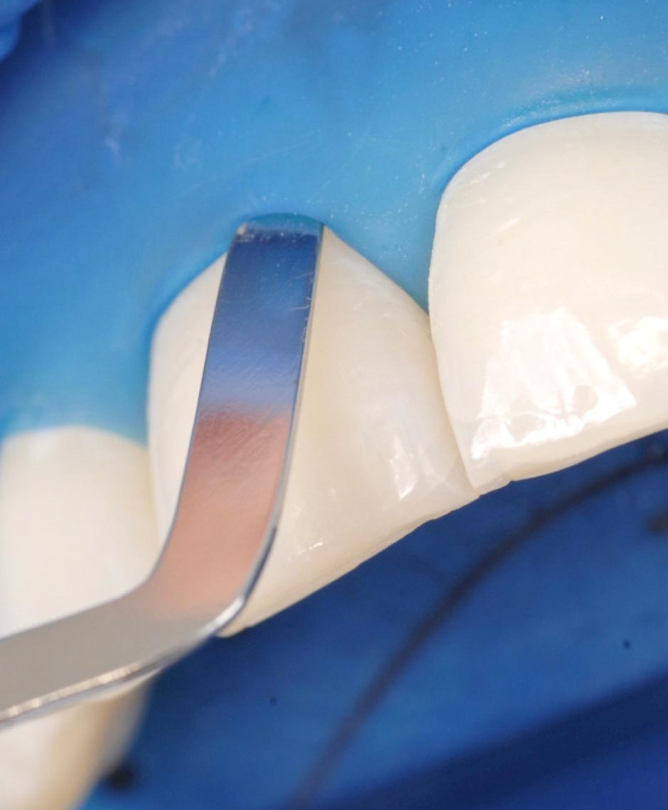 Nahaufnahme der Isolation mit OptraDam im Frontzahnbereich