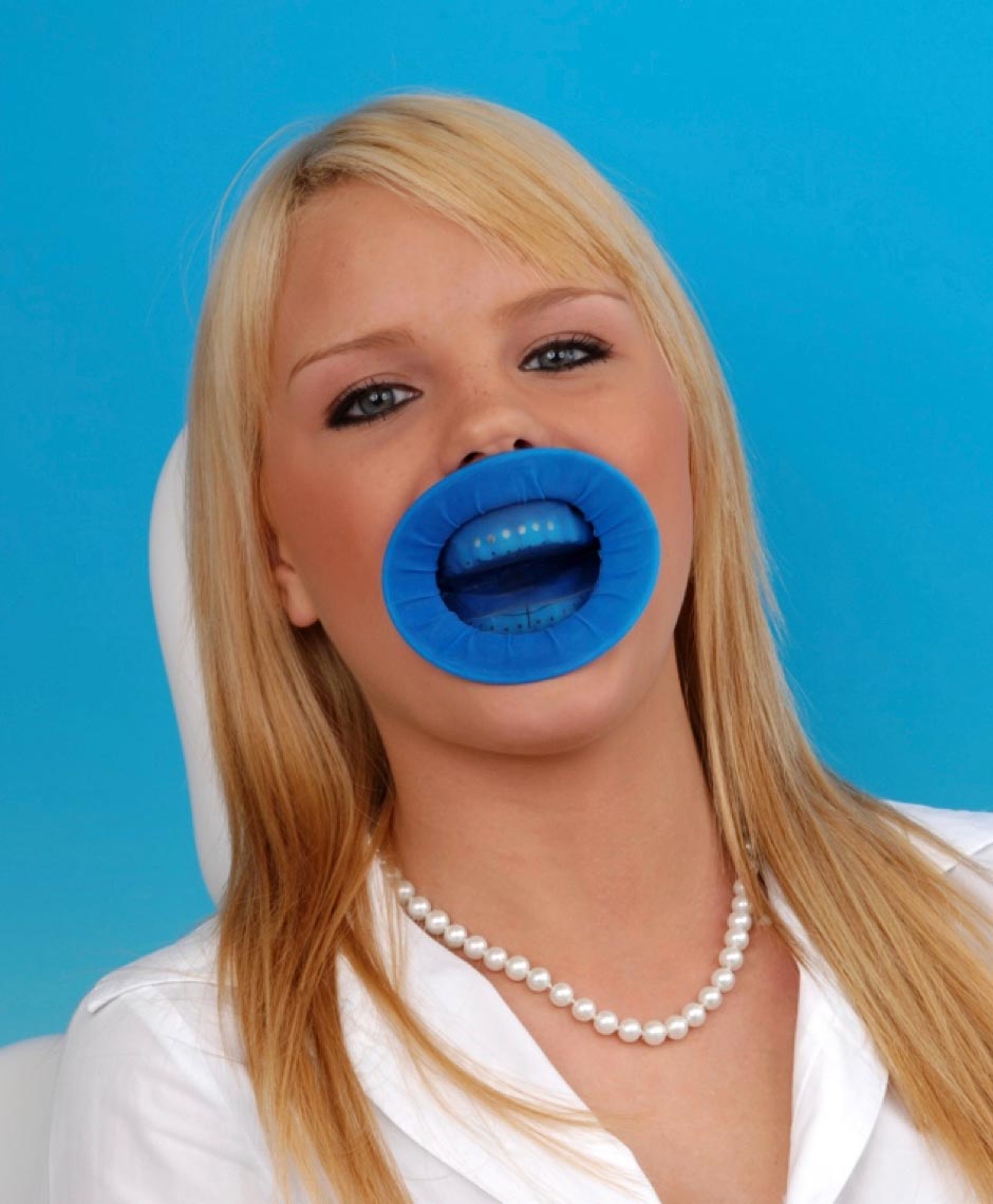 OptraDam eingesetzt bei Patientin zur sicheren Trockenlegung