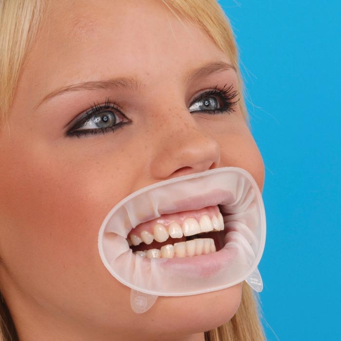 Patientin mit eingesetztem OptraGate zur sanften Lippen- und Wangenretraktion