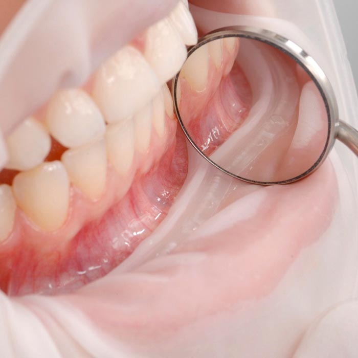 OptraGate im Mund – gleichmäßige Retraktion ohne sichtbare Druckstellen