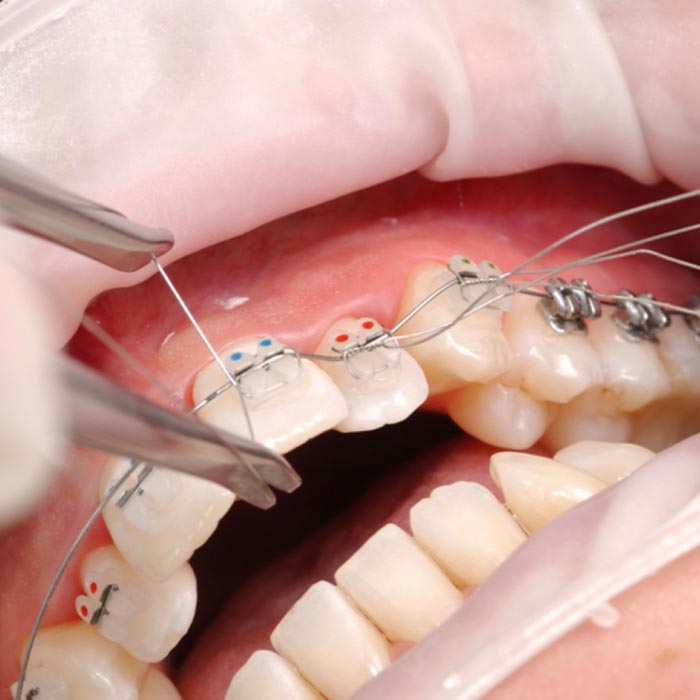 OptraGate in der Kieferorthopädie für freien Zugang und bessere Sicht