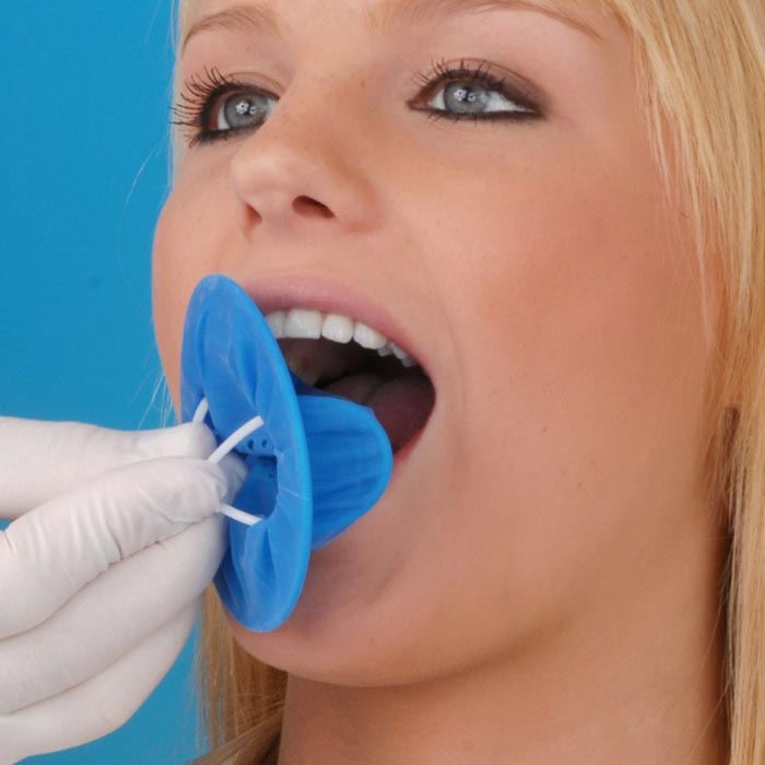 Einsetzen von OptraDam bei Patientin zur dentalen Isolation