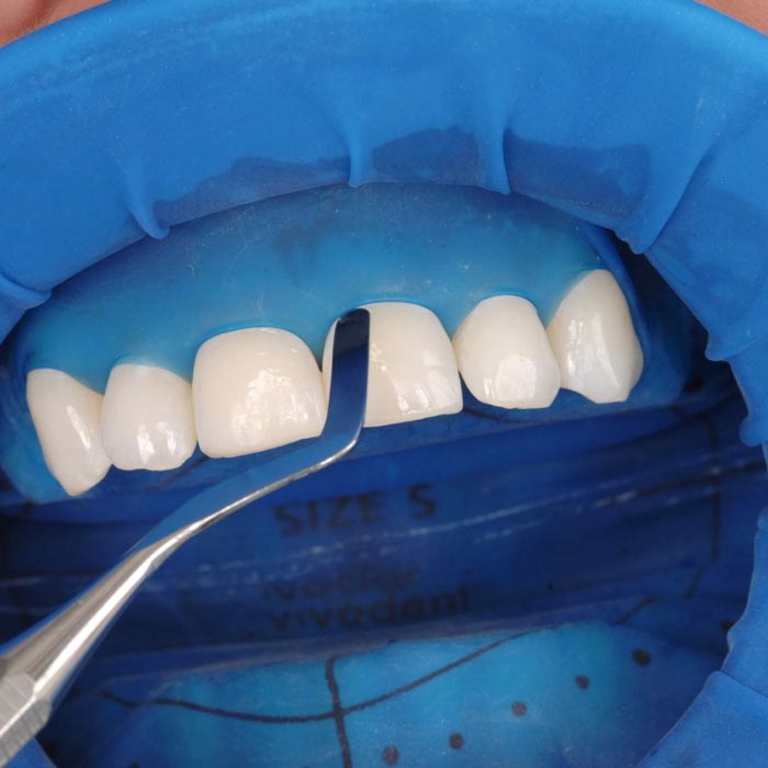 Isolation der Frontzähne mit OptraDam für präzises Arbeiten